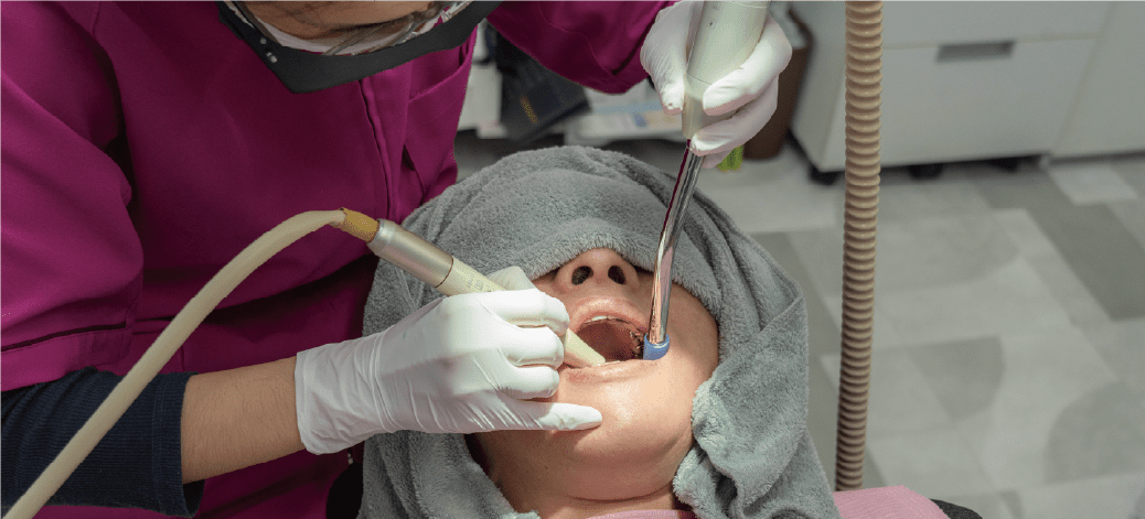 歯のクリーニングの画像