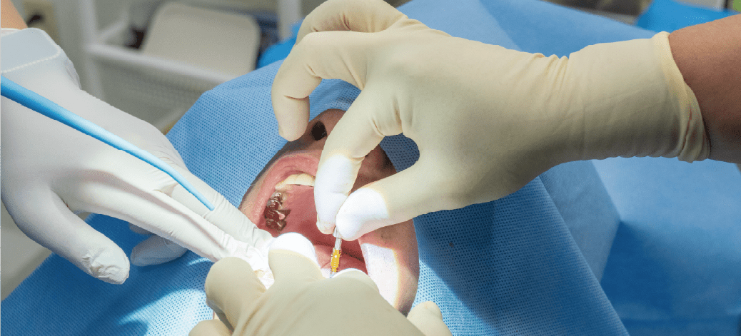 インプラント手術の画像