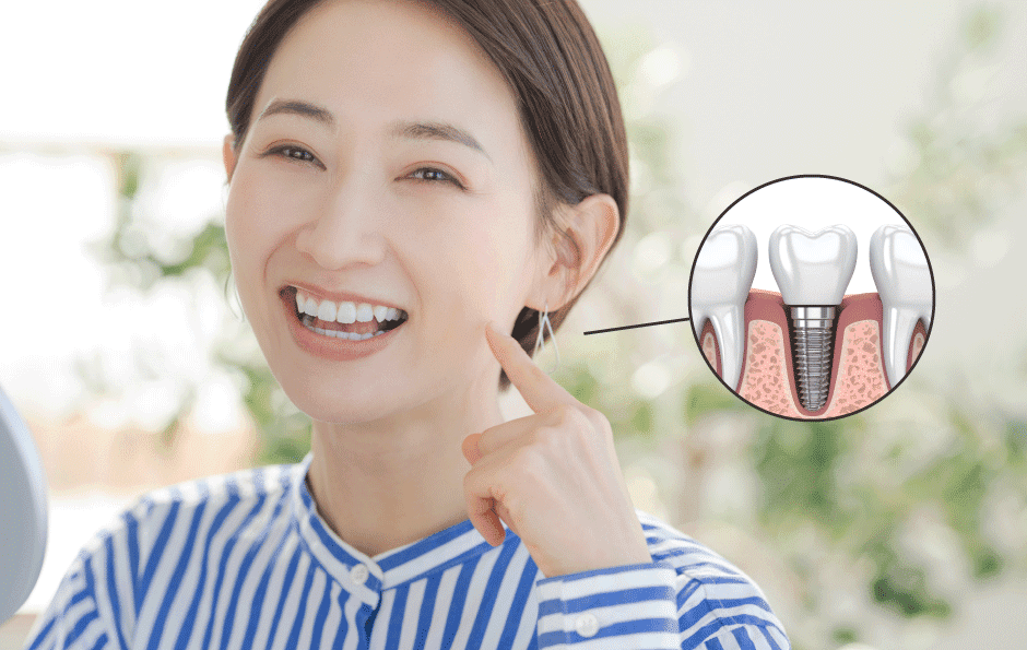 インプラント治療のイメージ写真