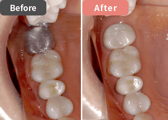 コンパス歯科クリニック センター南 セラミック治療症例写真