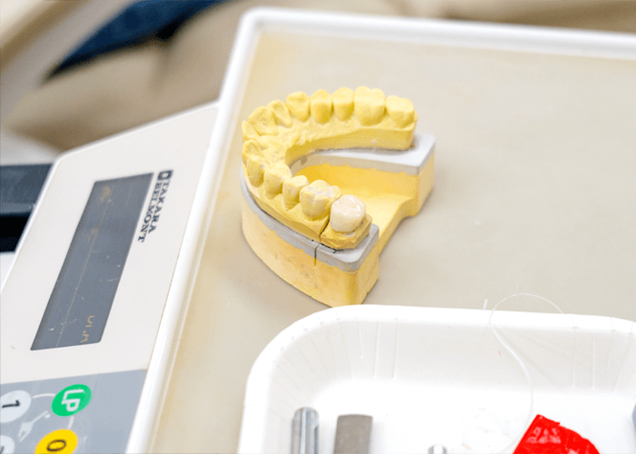 実際のセラミック歯と口内の模型