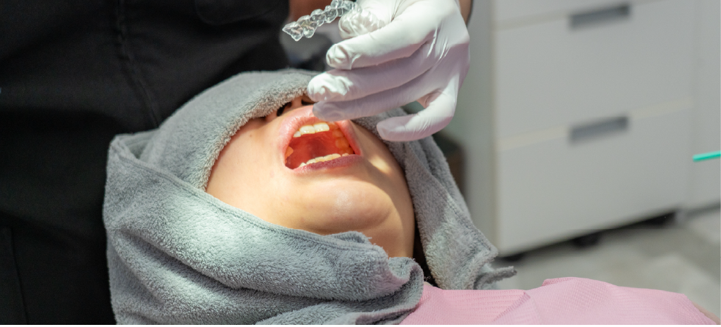 マウスピース完成・矯正治療開始の画像