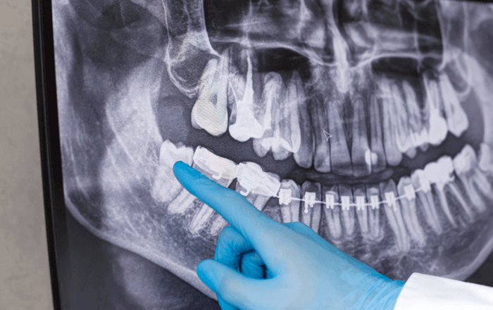 親知らずのレントゲン写真